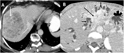 Editorial: Role of imaging in biliary tract cancer: diagnosis, staging, response prediction and image-guided therapeutics